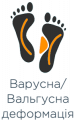 Вальгусна деформація